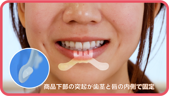 商品下部の突起が歯茎と唇の内側で固定